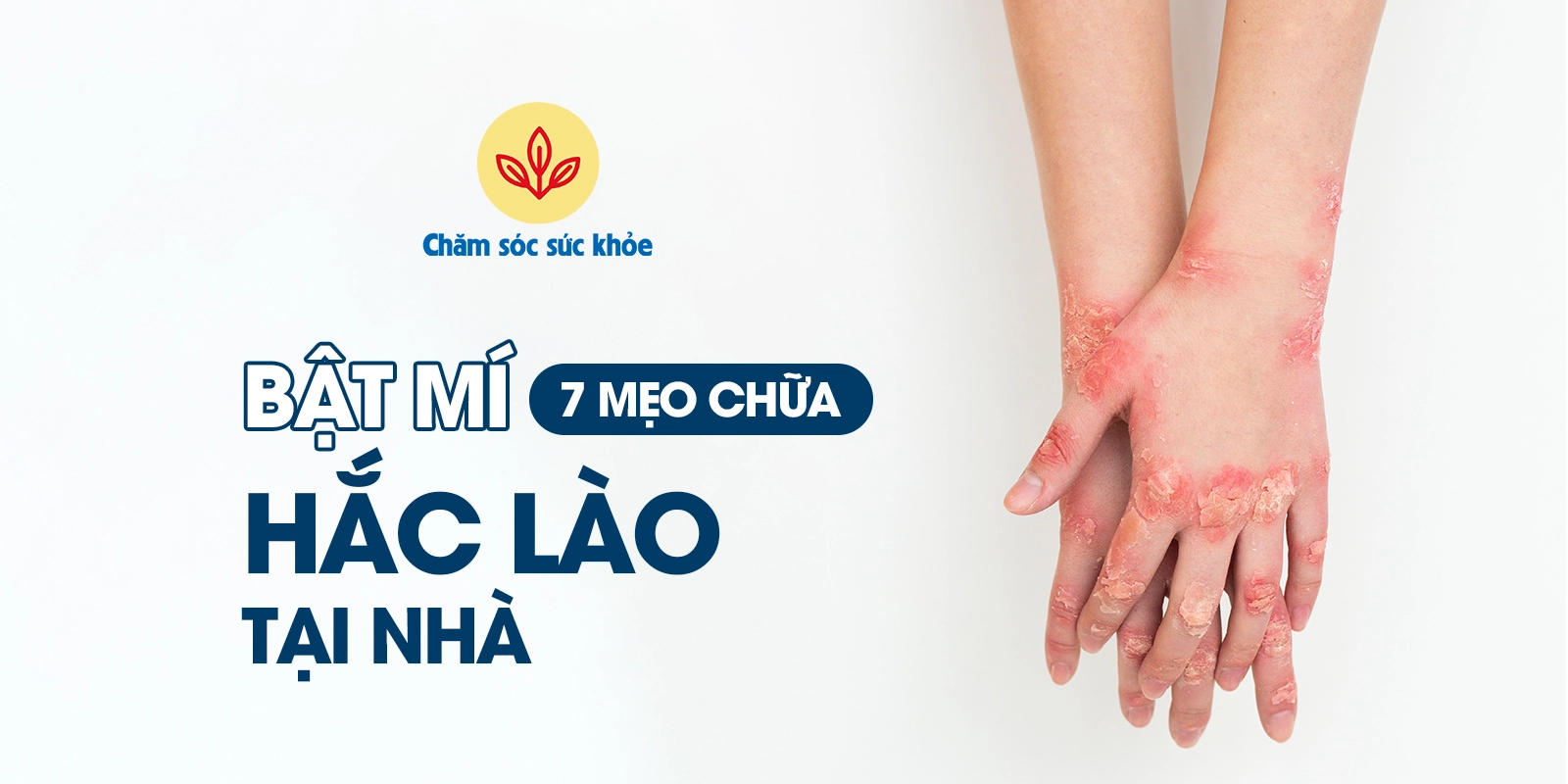 mẹo chữa hắc lào tại nhà