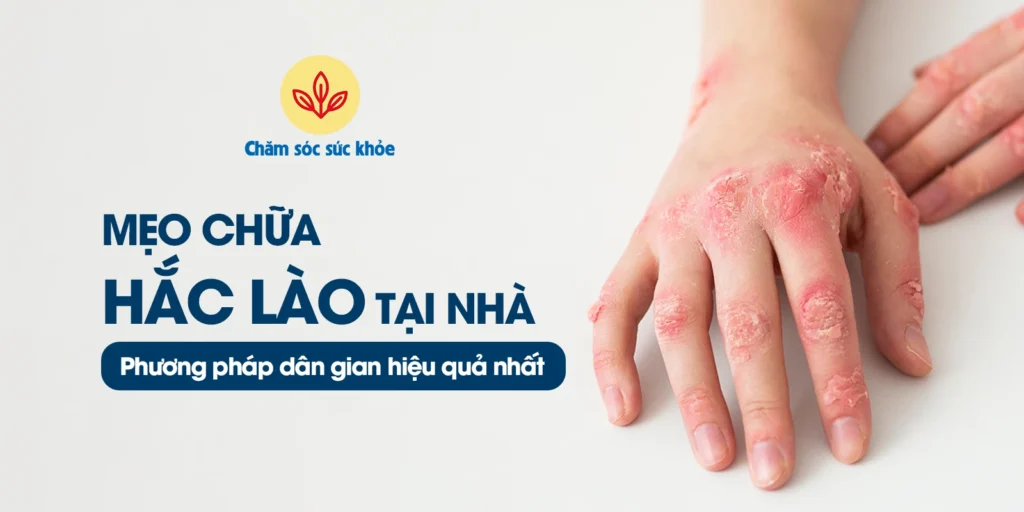 mẹo chữa hắc lào