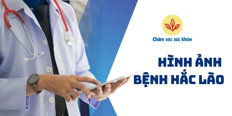 hình ảnh bệnh hắc lào